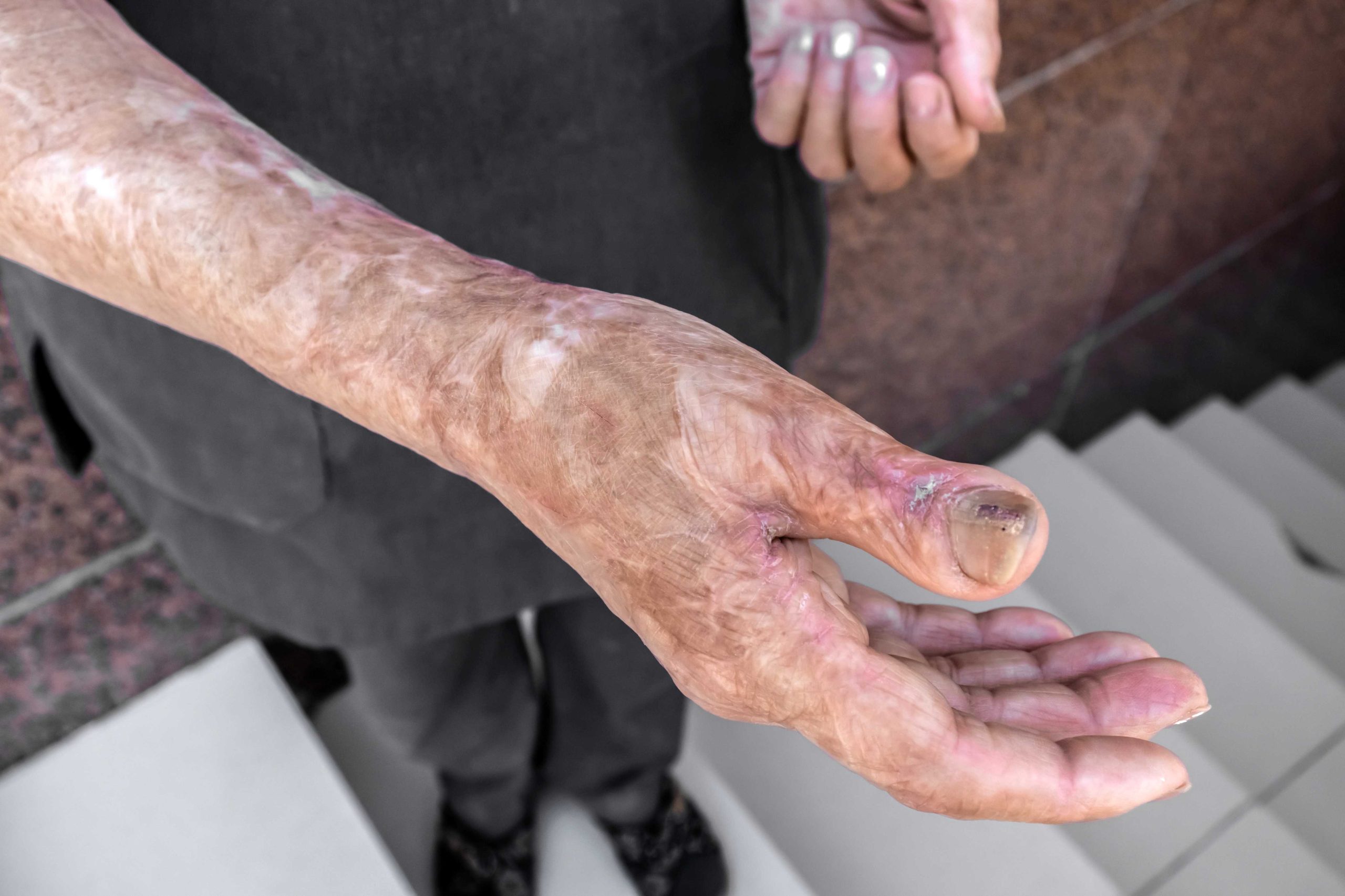 BurnInjuries-scaled.jpg